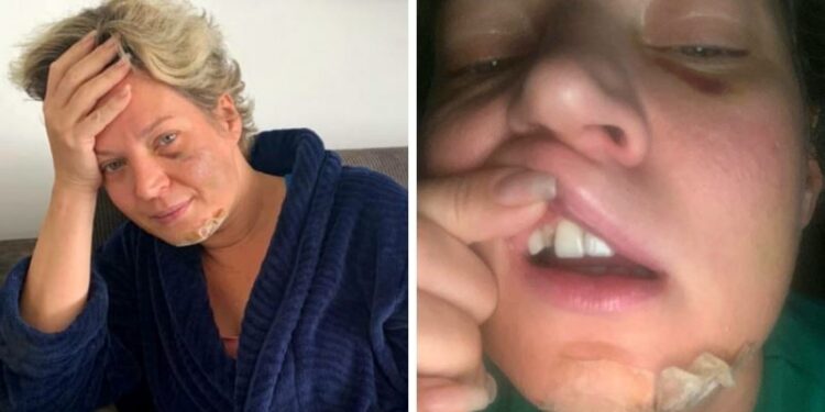 Polícia Civil do DF conclui que Joice Hasselmann sofreu queda e não foi agredida