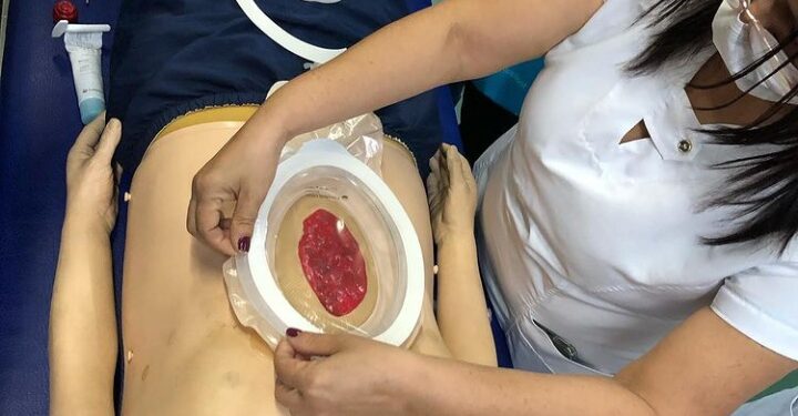 Investimentos em novas tecnologias refletem na melhor assistência ao paciente ostomizado no Huse
