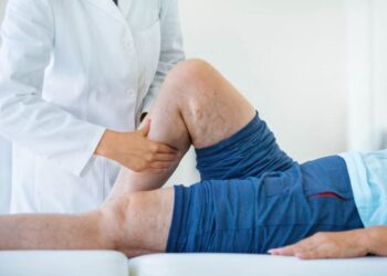 Homens também tem varizes: descuido com a saúde vascular pode agravar os casos
