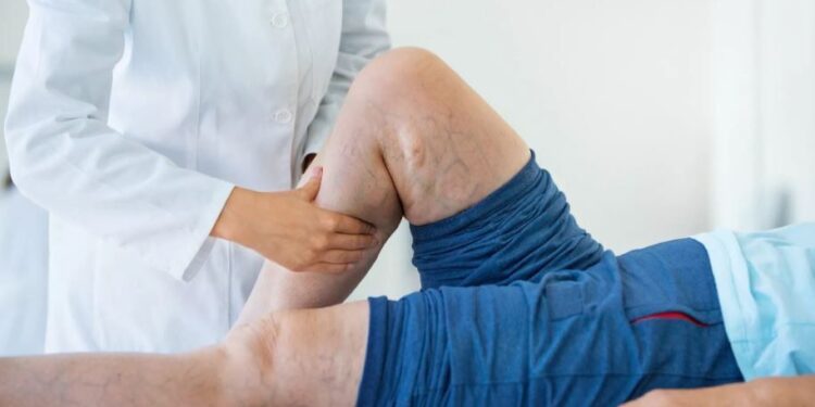 Homens também tem varizes: descuido com a saúde vascular pode agravar os casos