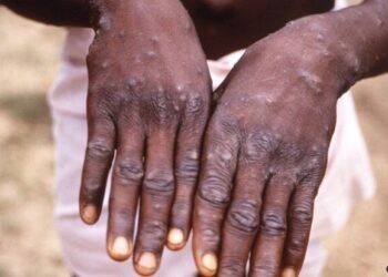 Brasileiro tem 1º caso de varíola dos macacos registrado na Alemanha