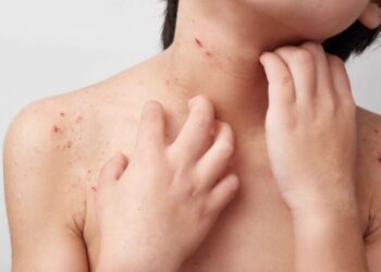 Casos de alergia em crianças aumentaram 7 vezes nos últimos 15 anos