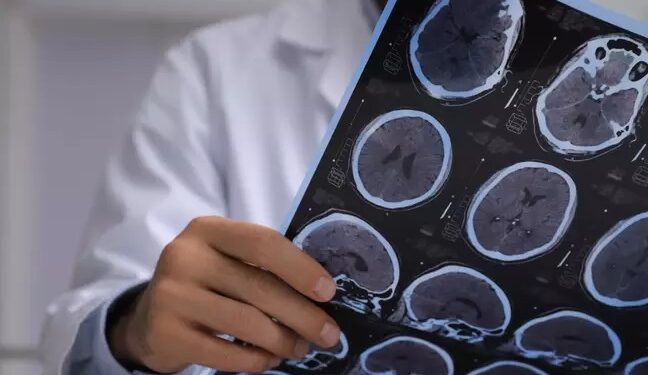 Esclerose múltipla: especialista esclarece mitos e verdades sobre a doença