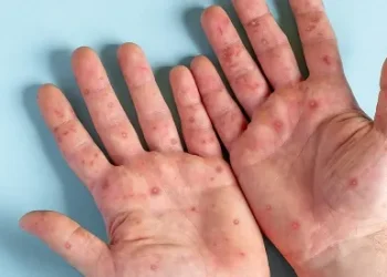 Sergipe registra mais dois casos de Monkeypox, diz Secretaria da Saúde