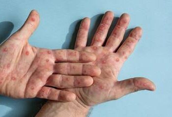 Sergipe registra o 25º caso de Monkeypox