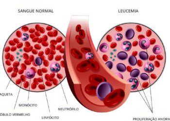 Anvisa autoriza pesquisa em pacientes com leucemia linfoide aguda B