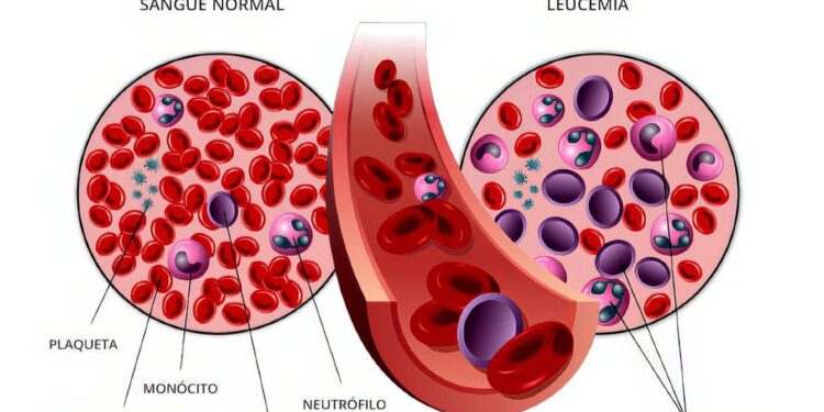 Anvisa autoriza pesquisa em pacientes com leucemia linfoide aguda B
