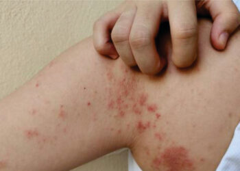 Dermatologista do Ipesaúde destaca importância do diagnóstico precoce da hanseníase