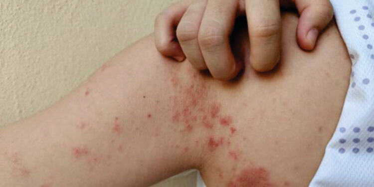 Dermatologista do Ipesaúde destaca importância do diagnóstico precoce da hanseníase