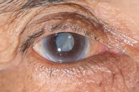 Risco de glaucoma aumenta com envelhecimento; entenda a doença