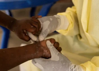 Saúde negocia compra de 25 mil doses de vacina contra mpox