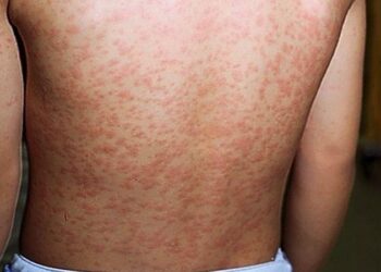 Oito em cada dez municípios brasileiros têm risco alto ou muito alto para sarampo