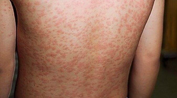 Oito em cada dez municípios brasileiros têm risco alto ou muito alto para sarampo