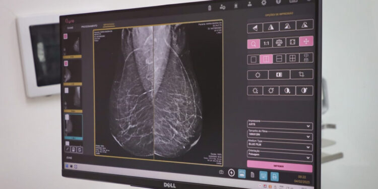 Saúde reforça importância do exame de mamografia para diagnóstico precoce do câncer de mama