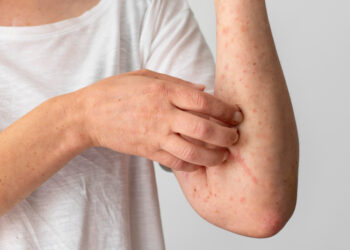 Poluição e microplásticos podem ter relação com o aumento dos casos de dermatite atópica