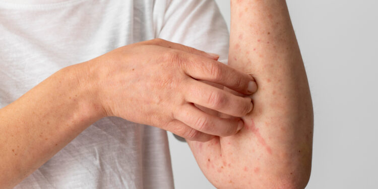 Poluição e microplásticos podem ter relação com o aumento dos casos de dermatite atópica