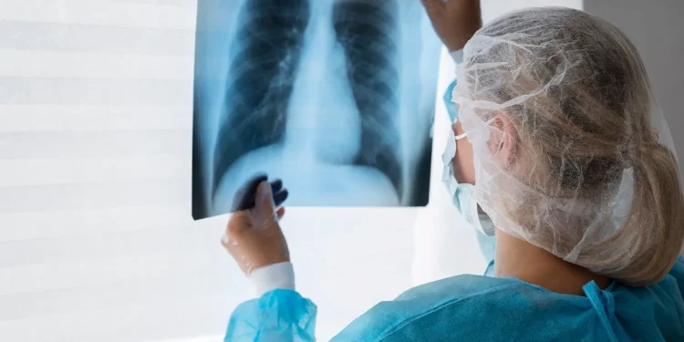 Câncer de pulmão: terapia-alvo reduz em 84% risco de morte