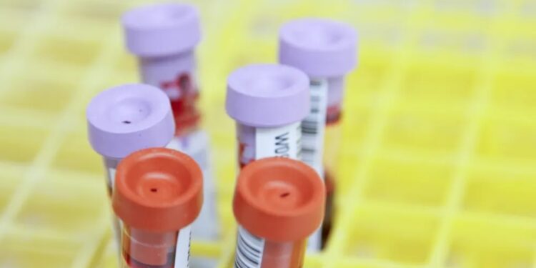 Novo estudo indica que exame de sangue pode prever Alzheimer em fase inicial